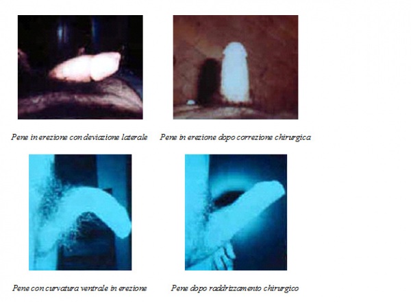 Le dimensioni e la forma del pene - Malattie del sistema genitale maschile